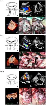 Undifferentiated Chordae Tendineae of the Mitral Valve: Large Cohort Study of a Rare Mitral Malformation